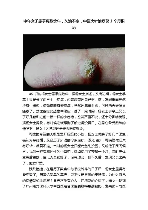 中年女子患掌疣数余年，久治不愈，中医火针治疗仅1个月根治