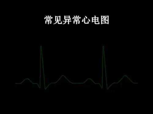 常见异常心电图