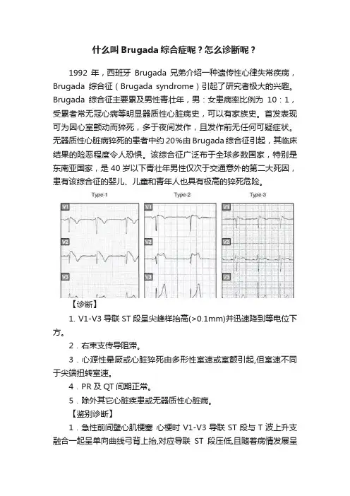 什么叫Brugada综合症呢？怎么诊断呢？