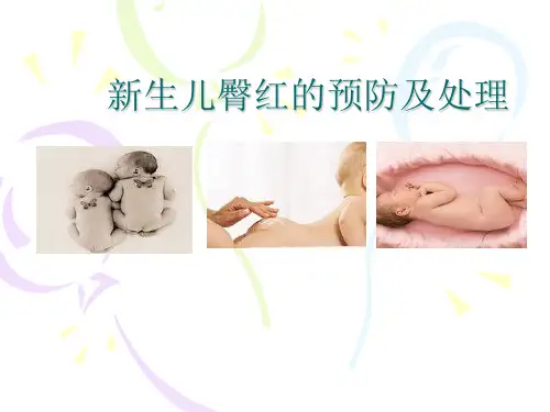 新生儿臀红的预防及护理