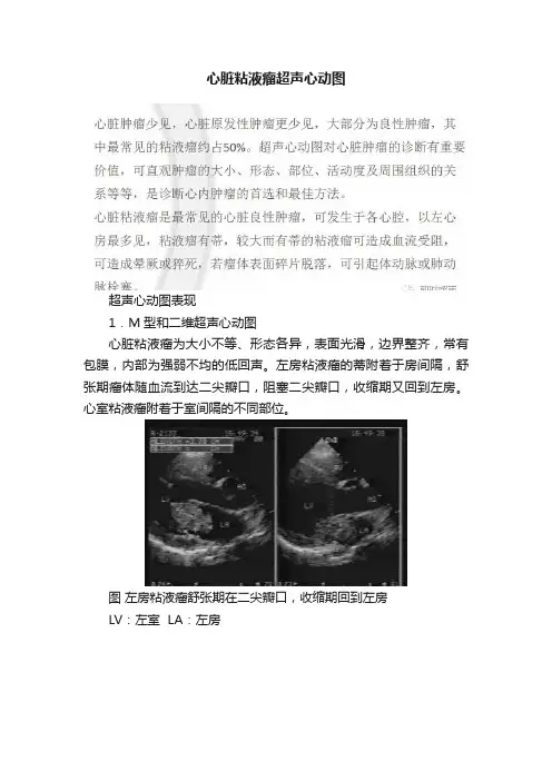 心脏粘液瘤超声心动图