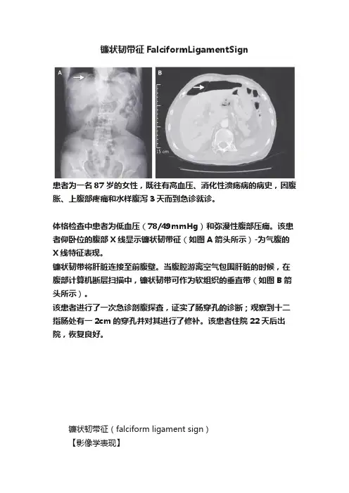 镰状韧带征FalciformLigamentSign