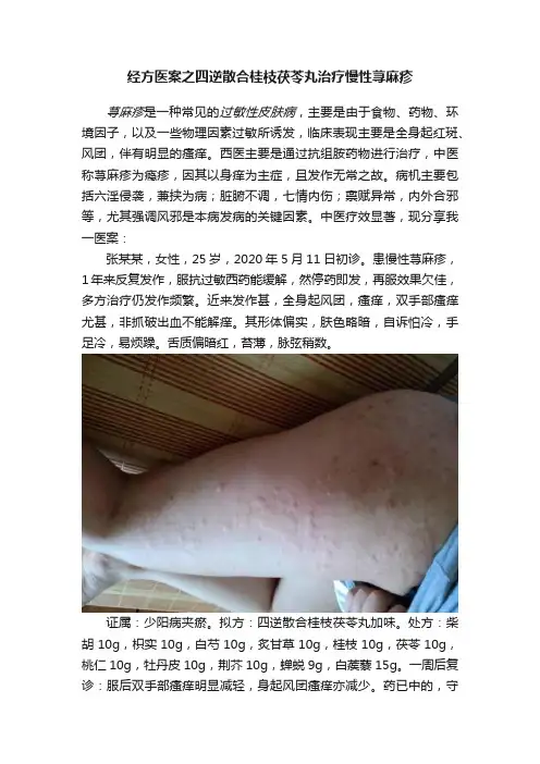 经方医案之四逆散合桂枝茯苓丸治疗慢性荨麻疹