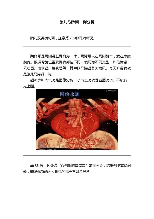 胎儿马蹄肾一例分析