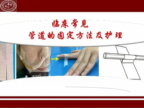 临床常见管道的固定方法及标识 ppt课件
