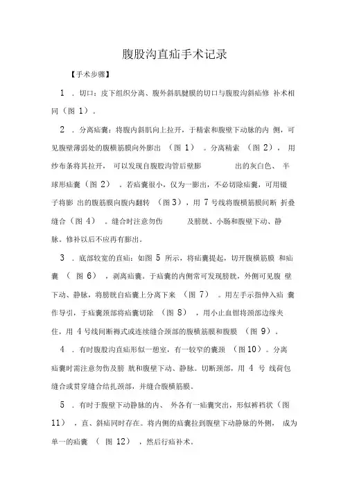 腹股沟直疝手术记录