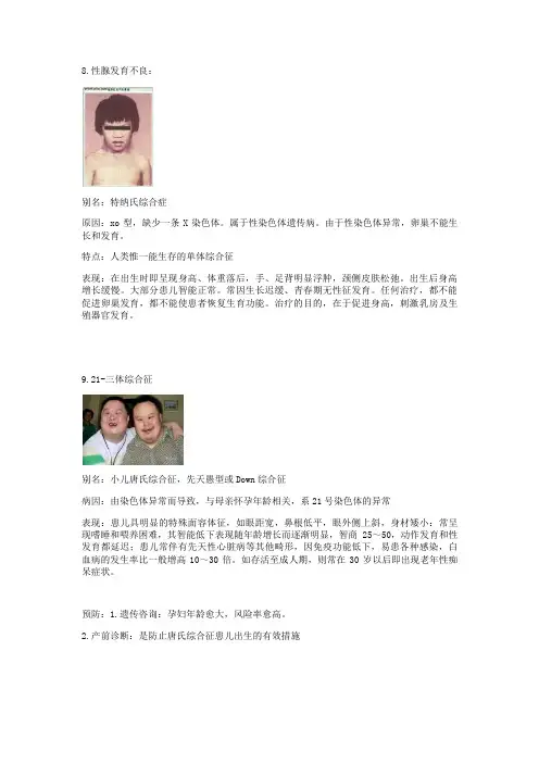 性腺发育不良：21-三体综合征猫叫综合征