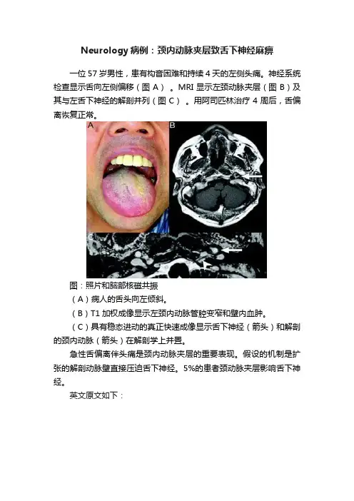 Neurology病例：颈内动脉夹层致舌下神经麻痹
