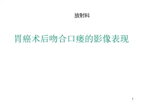 胃癌术后吻合口瘘的影像学表现ppt课件