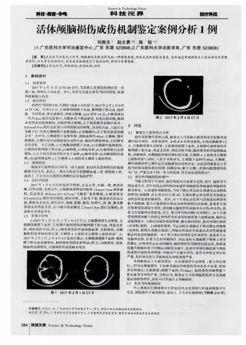 活体颅脑损伤成伤机制鉴定案例分析1例
