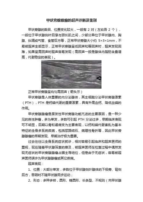 甲状旁腺腺瘤的超声诊断及鉴别