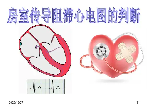房室传导阻滞心电图的判读 ppt课件