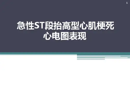 急性ST段抬高型心肌梗死心电图表现ppt课件