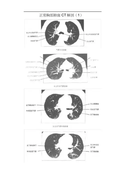 正常胸部CT解剖(肺窗和纵隔窗) 2