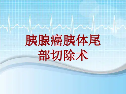 手术讲解模板：胰腺癌胰体尾部切除术