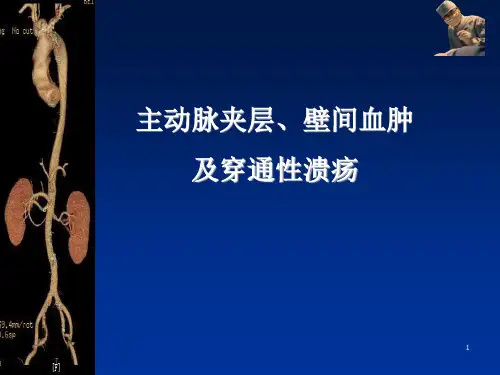主动脉夹层、壁间血肿及穿通性溃疡的影像诊断与鉴别诊断PPT参考课件