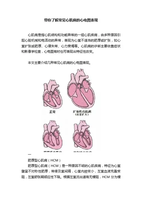 带你了解常见心肌病的心电图表现