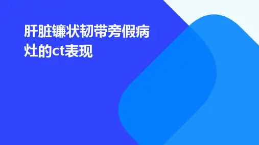肝脏镰状韧带旁假病灶的CT表现