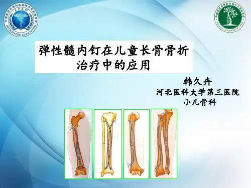 医促会弹性髓内钉规范化操作