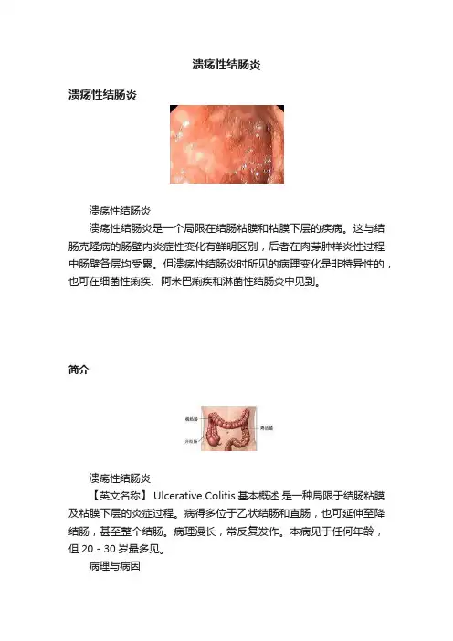 溃疡性结肠炎