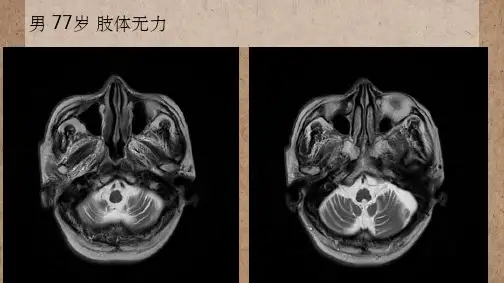 橄榄桥脑小脑萎缩的影像学诊断