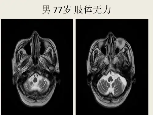 橄榄桥脑小脑萎缩的影像学诊断