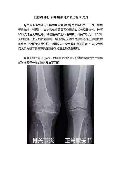 【医学科普】详细解读骨关节炎的X光片