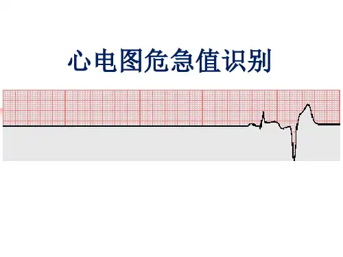 心电图危急值识别