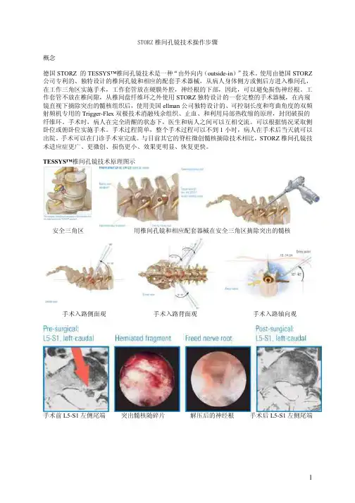 全部步骤(椎间孔镜)手术