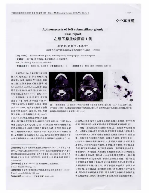 左颌下腺放线菌病1例