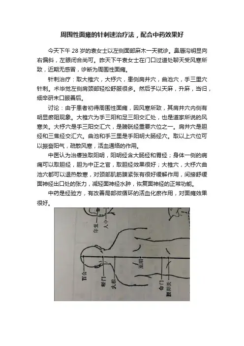 周围性面瘫的针刺速治疗法，配合中药效果好