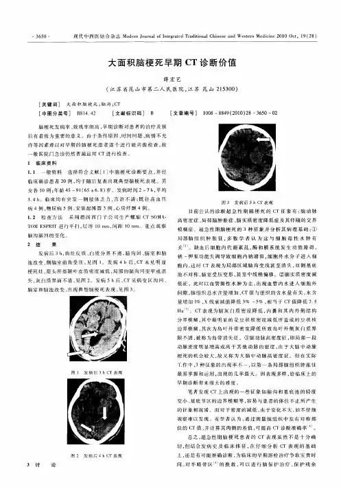 大面积脑梗死早期CT诊断价值