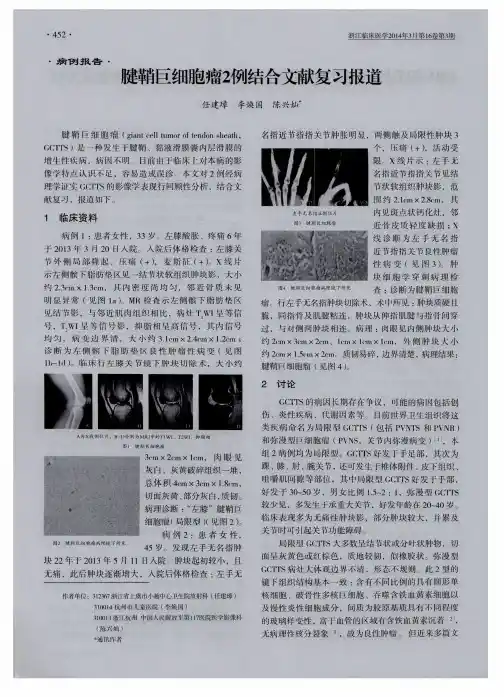 腱鞘巨细胞瘤2例结合文献复习报道