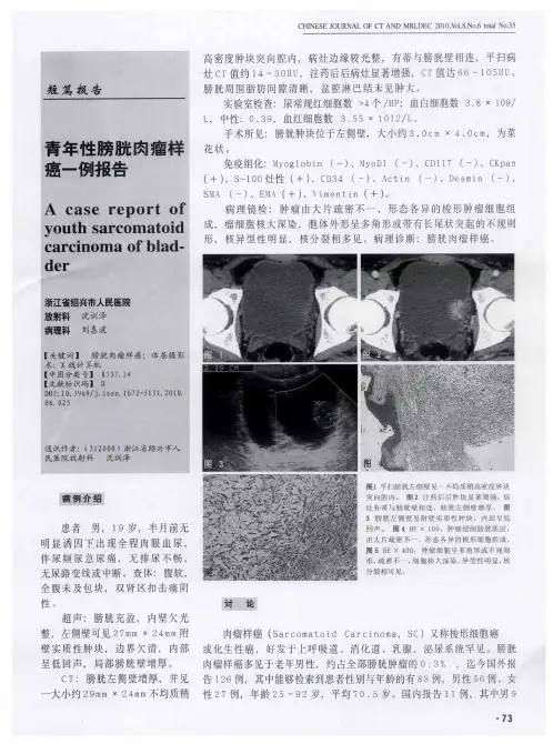 青年性膀胱肉瘤样癌一例报告