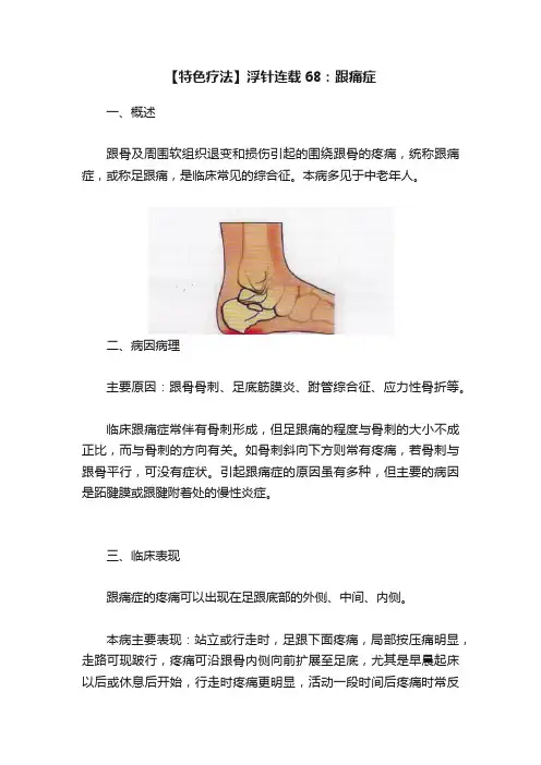 【特色疗法】浮针连载68：跟痛症