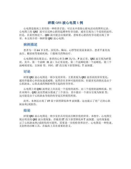 碎裂QRS波心电图1例