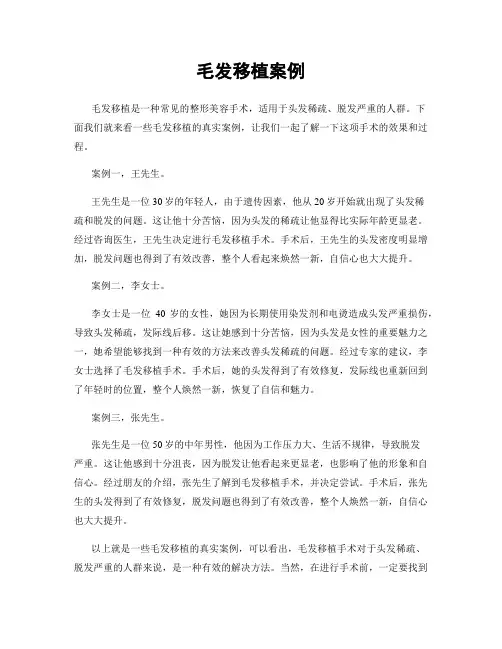 毛发移植案例