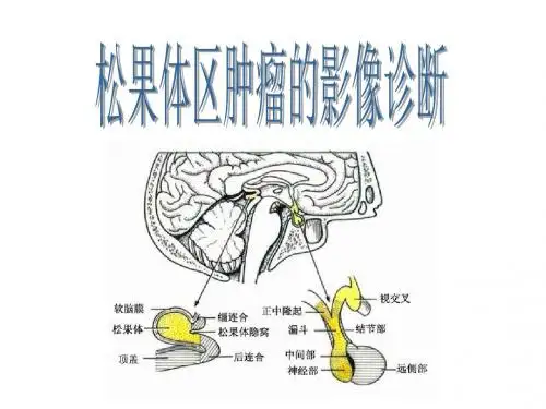 陈主任放射影像工作日志之5：松果体区肿瘤