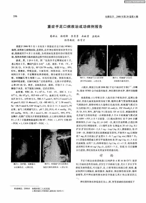 重症手足口病救治成功病例报告