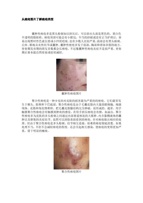 青春痘类型