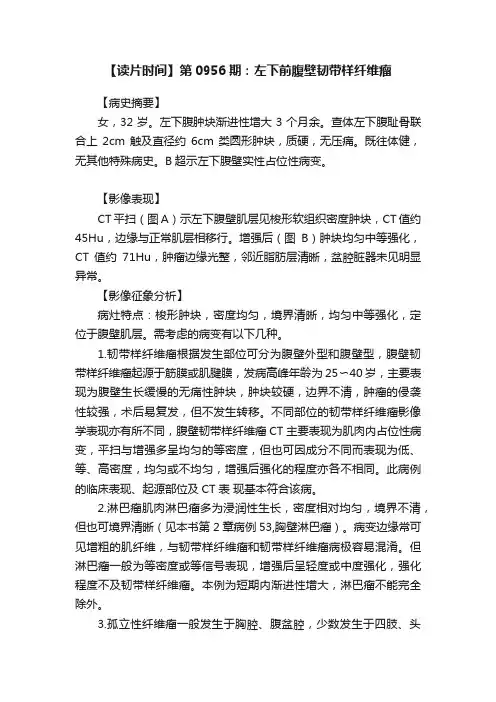 【读片时间】第0956期：左下前腹壁韧带样纤维瘤