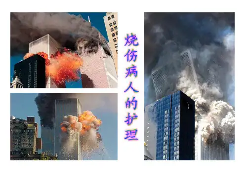 烧伤病人的护理ppt课件 (完整)