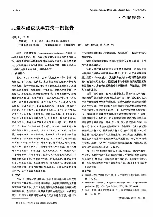 儿童神经皮肤黑变病一例报告