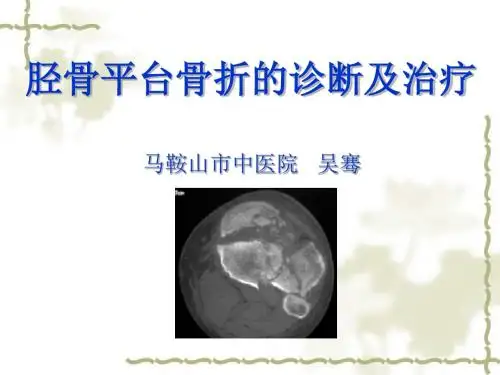 胫骨平台骨折的诊断及治疗 ppt课件