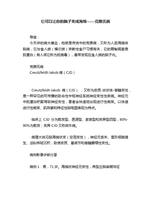 它可以让你的脑子变成海绵——克雅氏病
