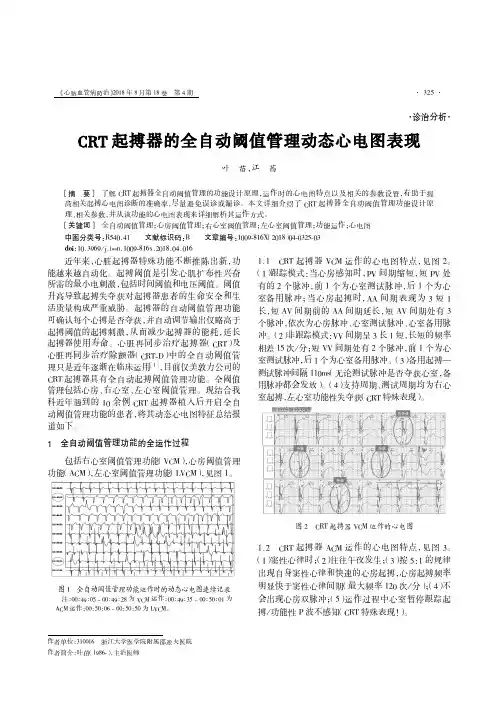 CRT起搏器的全自动阈值管理动态心电图表现