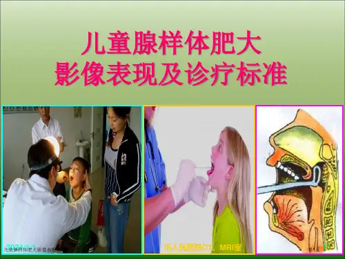 儿童腺样体肥大影像表现及诊断标准