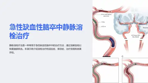 急性缺血性脑卒中静脉溶栓治疗