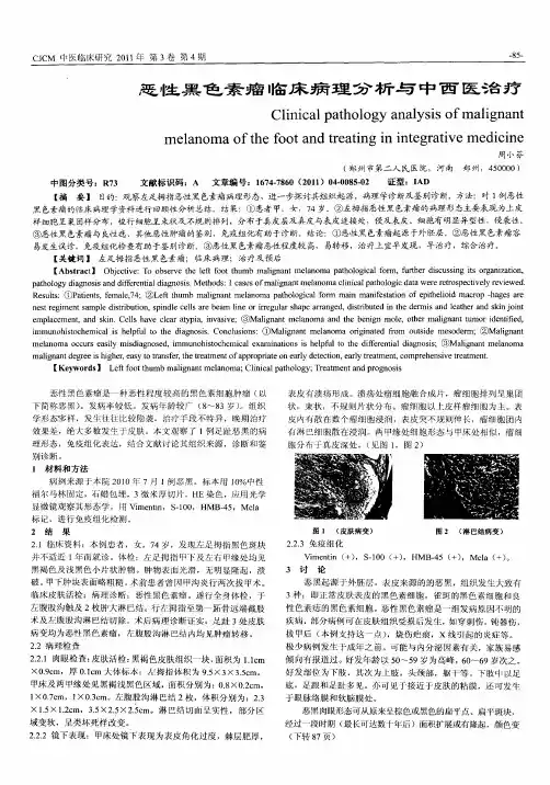 恶性黑色素瘤临床病理分析与中西医治疗