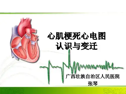 心肌梗死心电图认识与变迁